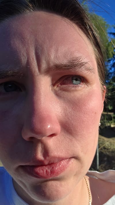 This is a close-up, eye-level, outdoor photograph of the face of a person with fair skin and dark hair. The person's gaze is directed towards the camera, with their head tilted slightly downwards and to the left. The lighting is strong and directional, creating shadows and highlighting the contours of the face. The person's right eye appears red and irritated, with visible blood vessels. The left eye is more obscured by shadow. The person has prominent lines on their forehead, and their lips are slightly parted. A portion of a gold chain necklace is visible on the right side of the frame. In the background, out of focus, are green trees and a bright blue sky, suggesting an outdoor setting, possibly a park or backyard. The location in Portland, United States of America is not identifiable from the visual information present in the image.