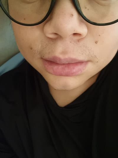 The image is a close-up, rotated view of a person's face, focusing on their nose, lips, and cheek. The person is wearing black-rimmed glasses. There are several small moles visible on the skin, particularly on the cheek and near the nose. Some light facial hair is also present. The lips are pink and appear to be slightly chapped or irritated, with a reddish hue. The person is wearing a black garment, likely a shirt or t-shirt, which takes up a significant portion of the right side of the frame. The background is dark, suggesting it could be indoors or at night. There is no visible text in the image. The lighting is direct, highlighting the textures of the skin and the lips. The overall impression is a candid shot, possibly taken by the person themselves, given the close-up perspective and the angle. The setting appears to be personal, likely indoors, given the lack of natural light cues and the subject's attire. No specific activity is evident beyond the person being present and their face being the focus.