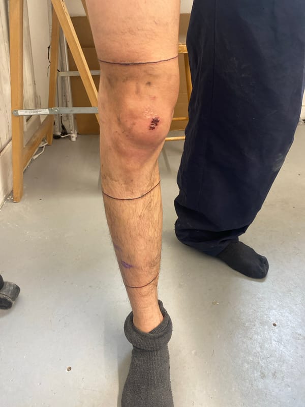Person with leg injuries documented in Paris