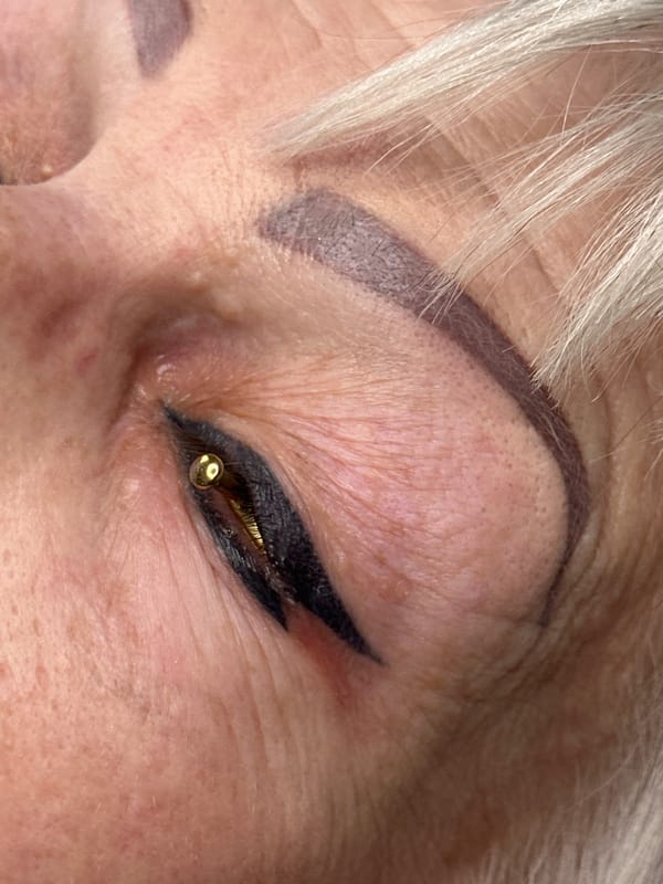 Cosmetic laser procedure performed in Riga, Latvia