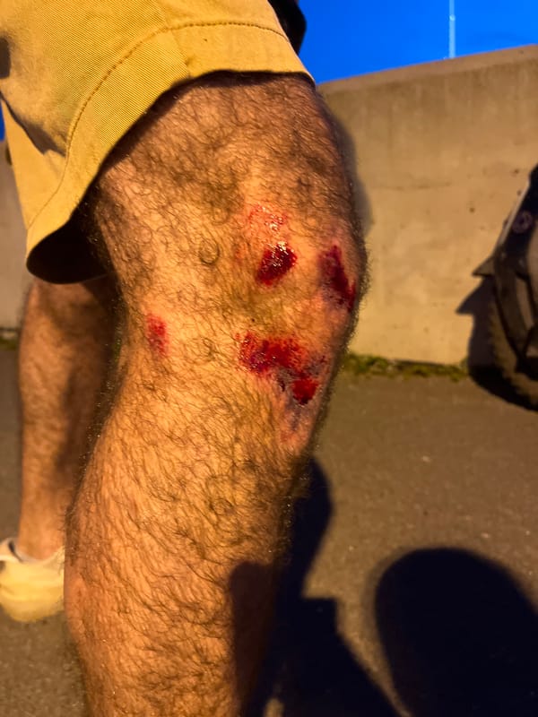 Fresh knee abrasions after a fall, Saint Petersburg