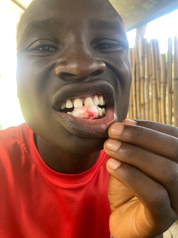 Dental extraction documented in Nigeria village