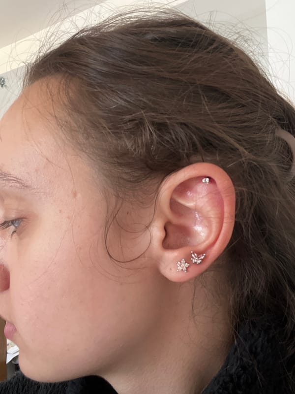 Ear acupuncture session documented in Saarbrücken