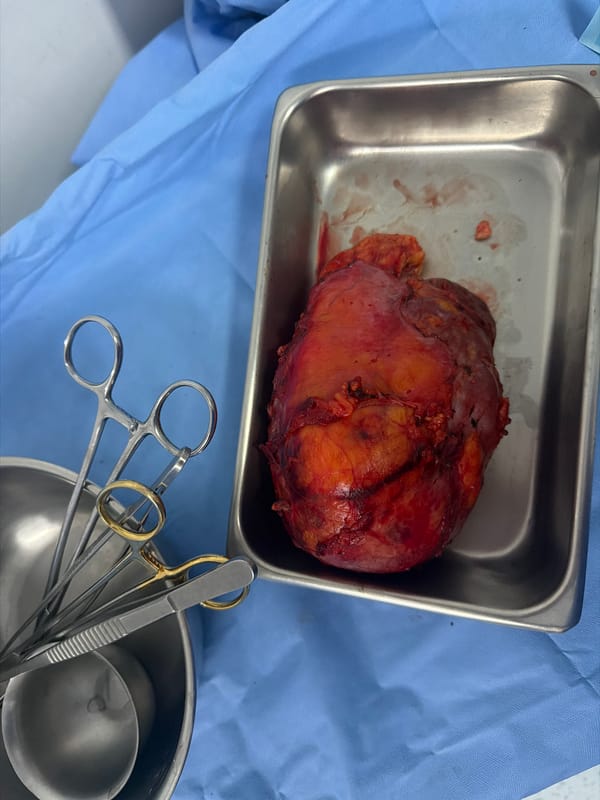 Surgical procedure with tissue mass documented in Puebla