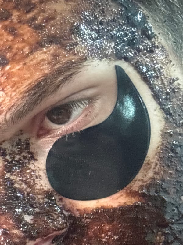 Person in eye patches photographed in Gyumri, Armenia