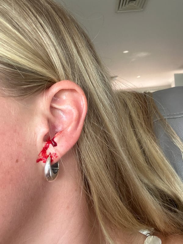 Woman suffers earlobe injury during poolside gathering in Bulli