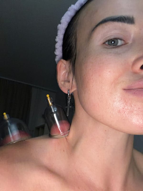 Person receives cupping therapy treatment in Saint Petersburg