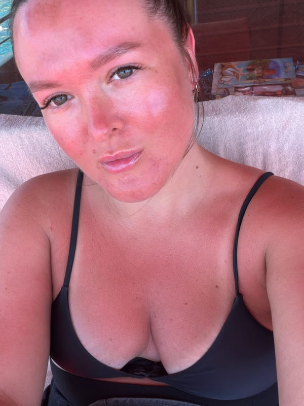 Severe sunburn case documented in Alanya, Turkey