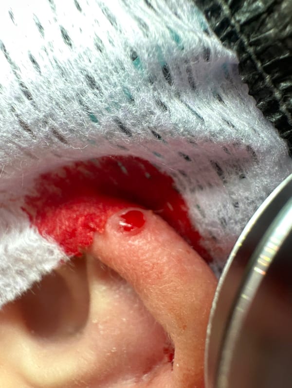 Person documents ear piercing procedure in Saratov, Russia